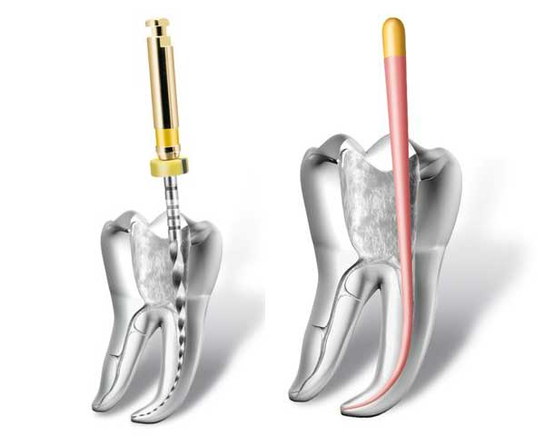 Endodontie Alba - Aiud