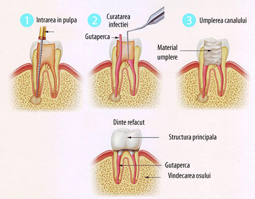 Endodontie Alba - Aiud