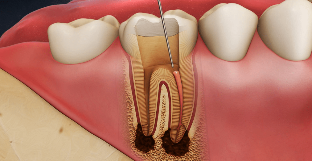 Endodontie Alba - Aiud