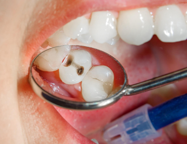 Terapia Cariilor Alba - Aiud