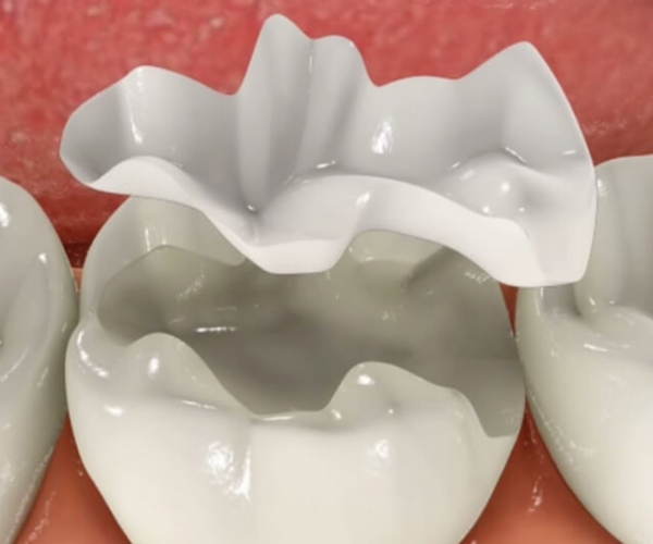 Terapia Cariilor Alba - Aiud